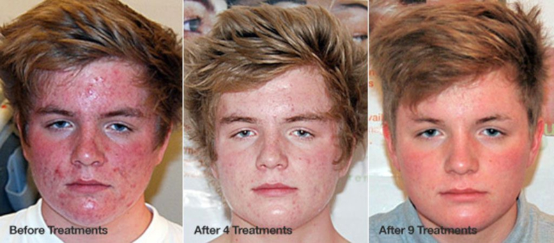 Resultaat van een DMK acnebehandeling bij een jonge man