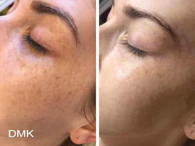 Foto's van het gezicht van een vrouw met hyperpigmentatie voor en na een DMK-behandeling