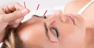 COSMETISCHE ACUPUNCTUUR