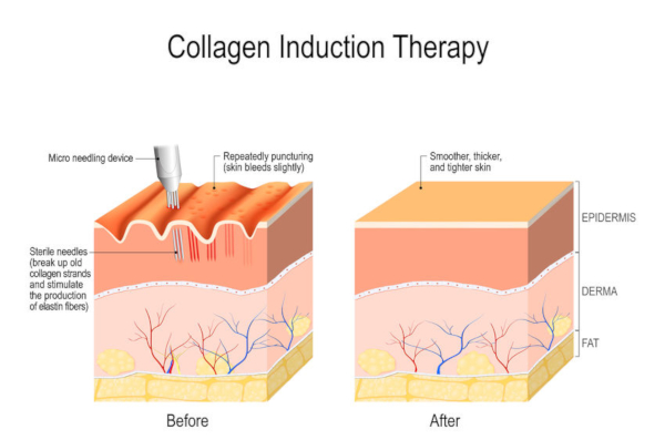 collageeninductietherapie: voor en na microneedling