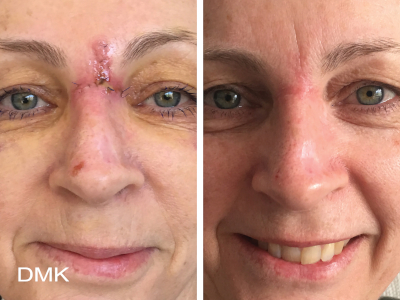 Het verdwijnen van een litteken op het gezicht van een vrouw na een DMK-behandeling